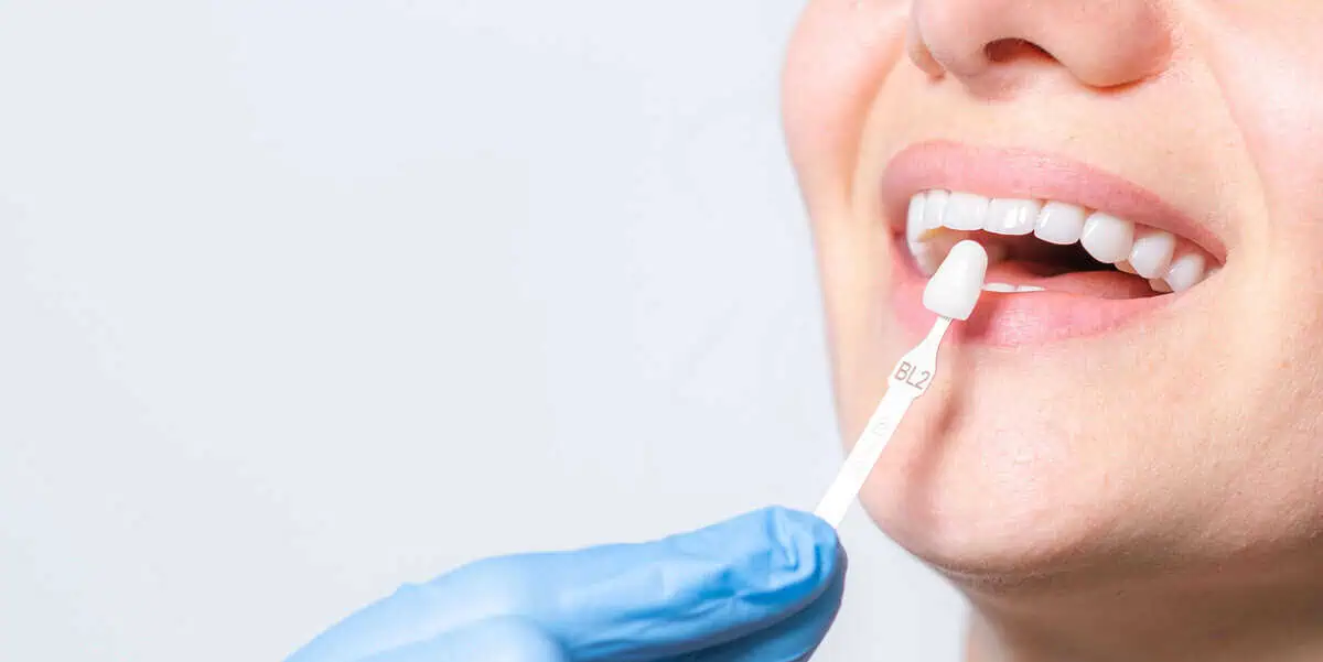 Veneers by Kelly Smile Design in Chicago, IL