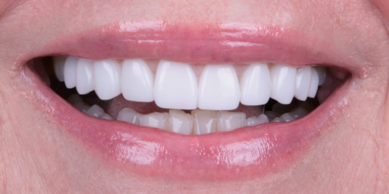 Smile enhancement | Kelly Smile Design in Chicago, IL