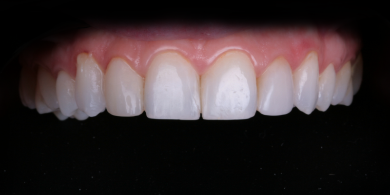 Professional teeth whitening | Kelly Smile Design in Chicago, IL
