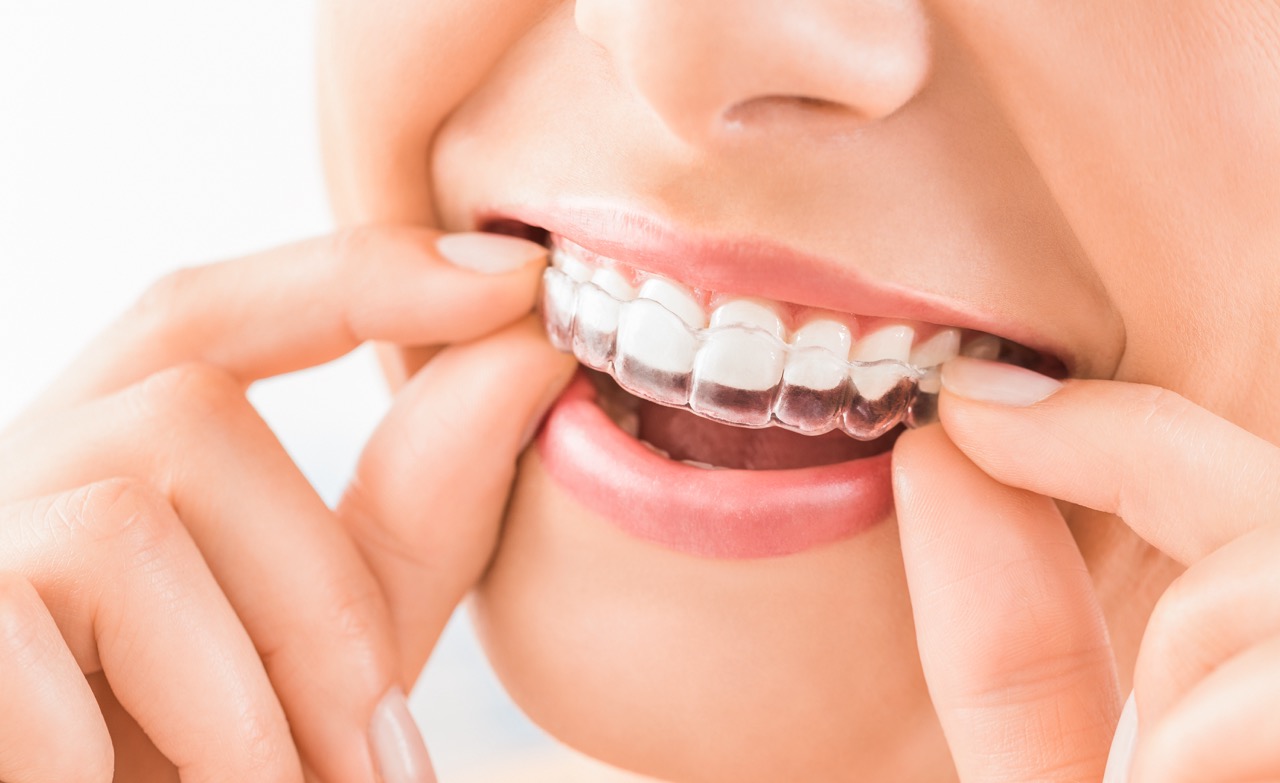INVISALIGNยฎ Smile by Kelly Smile Design