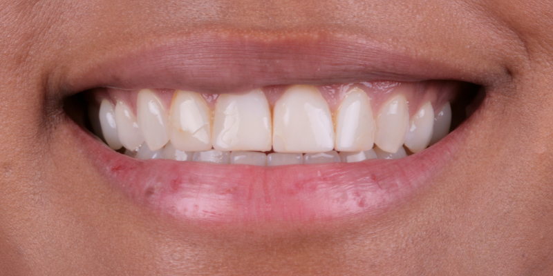 Maria Two Smile transformation | Kelly Smile Design in Chicago, IL