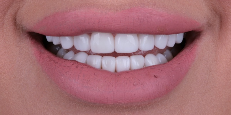 Cosmetic dentistry by Kelly Smile Design in Chicago