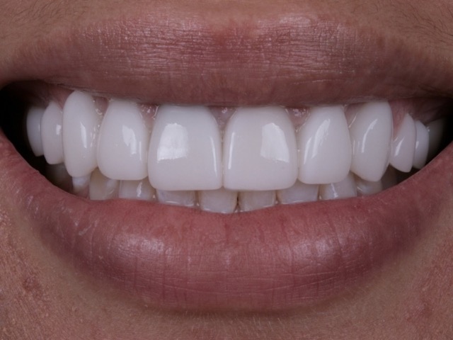 Bright smile therapy at Kelly Smile Design in Chicago