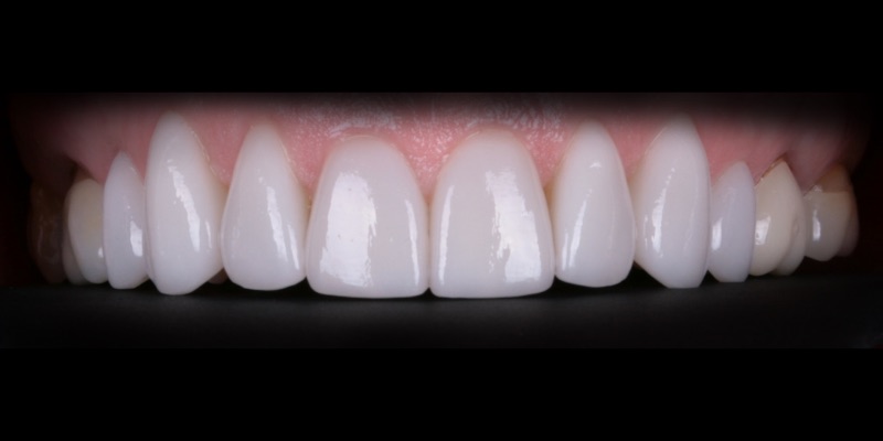 Kaminski Two in Kelly Smile Design in Chicago