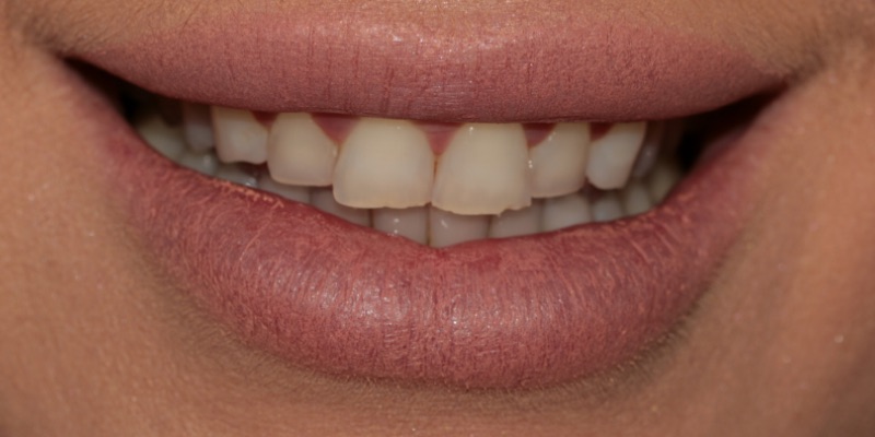 Dental veneers by Kelly Smile Design in Chicago