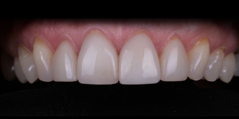 Denise two at Kelly Smile Design in Chicago, IL