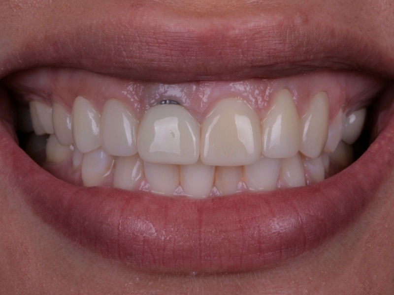 Smile Rejuvenation by Kelly Smile Design in Chicago