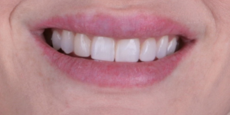 Karen two in Kelly Smile Design in Chicago IL