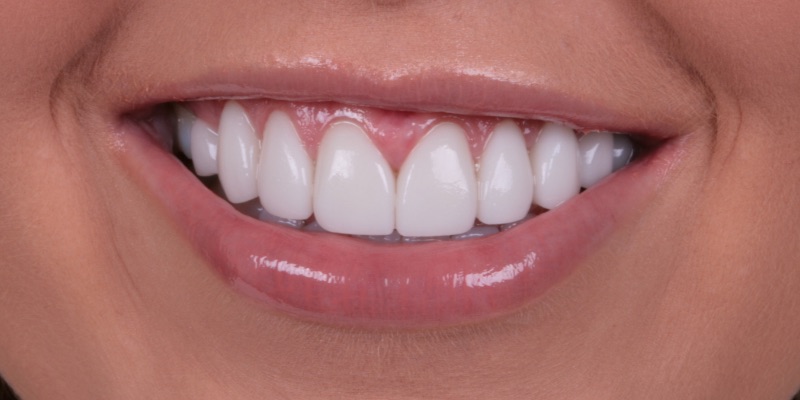 Johnson two | Kelly Smile Design in Chicago