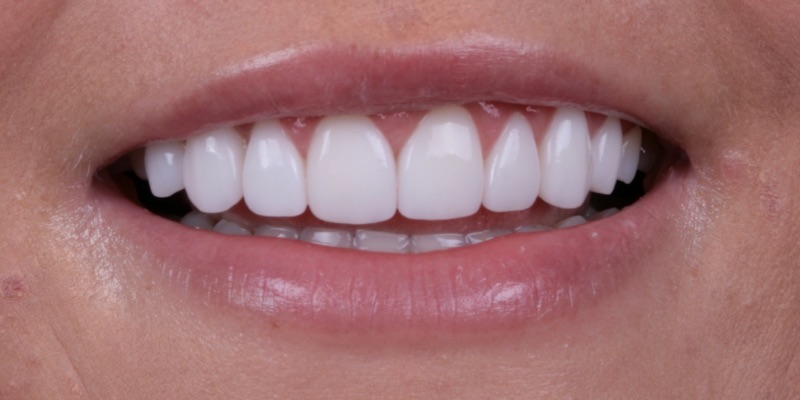 Zalewski two in Kelly Smile Design in Chicago