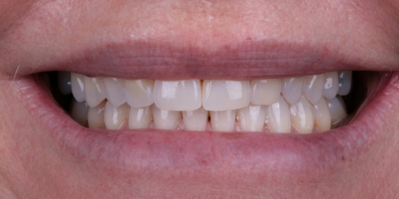 Elsaden one | Kelly Smile Design in Chicago, IL