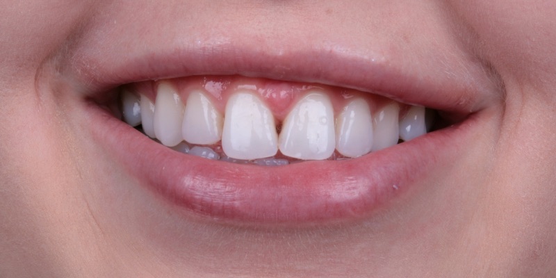Johnson two | Kelly Smile Design in Chicago