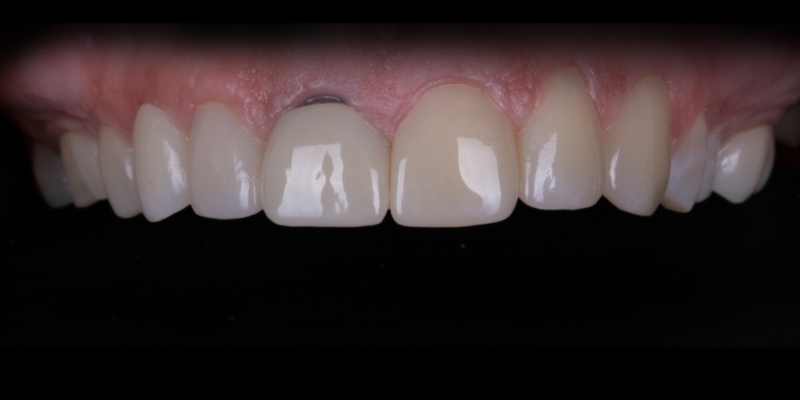 Lisa two at Kelly Smile Design in Chicago