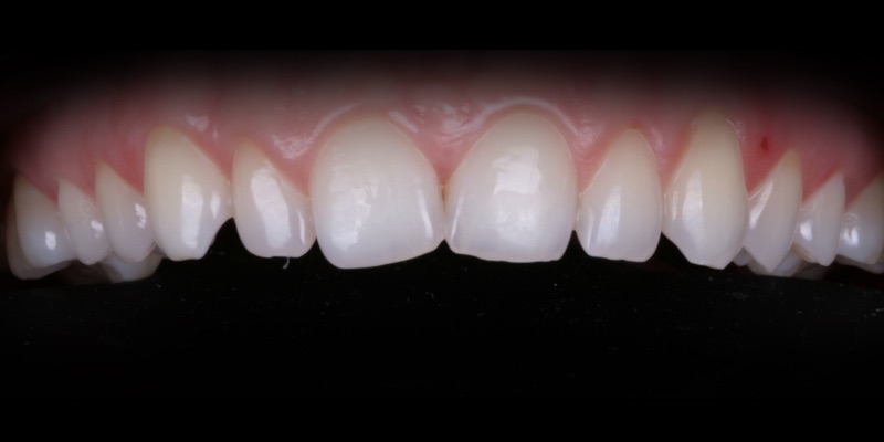 Zaliwinski three in Kelly Smile Design in Chicago