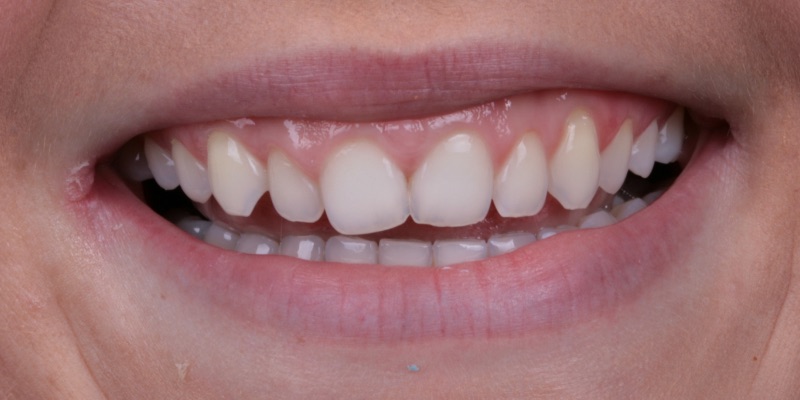 Zalewski two at Kelly Smile Design in Chicago
