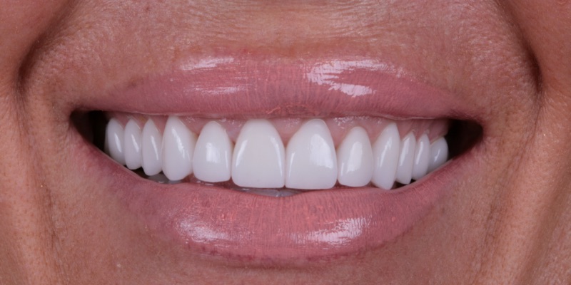 Nicole two | Kelly Smile Design in Chicago