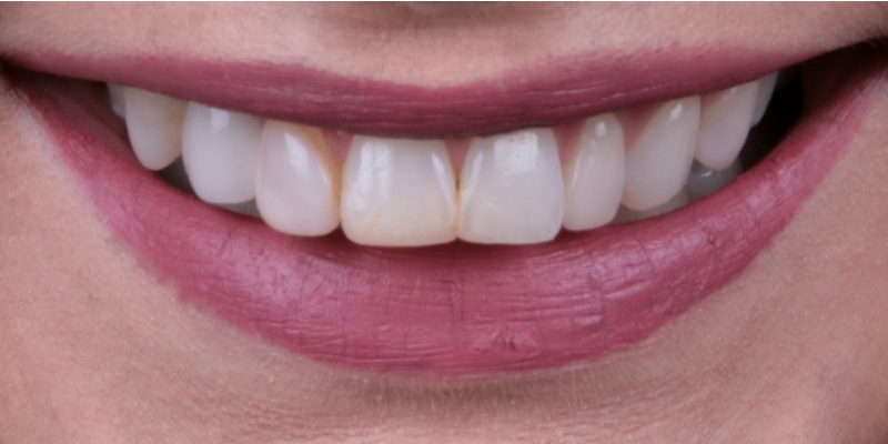 Lexi one | Kelly Smile Design in Chicago, IL