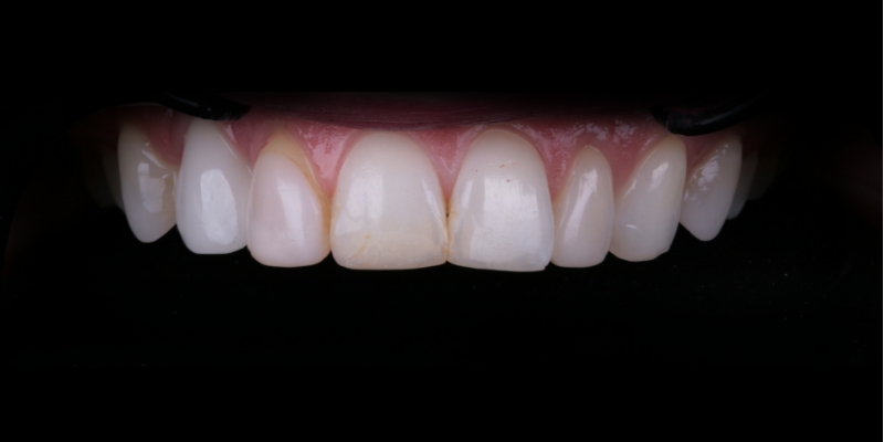 Lexi two at Kelly Smile Design in Chicago, IL