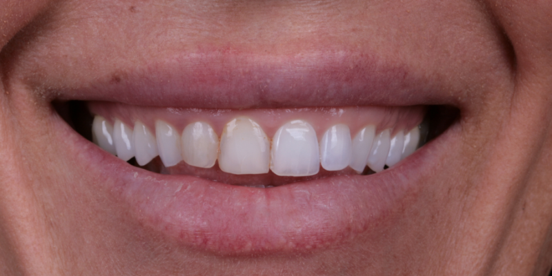Nicole two | Kelly Smile Design in Chicago