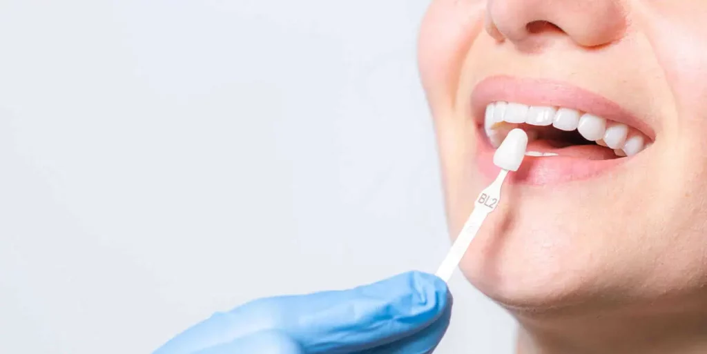 Veneers by Kelly Smile Design in Chicago, IL