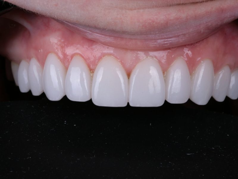 Smile Brightening by Kelly Smile Design in Chicago