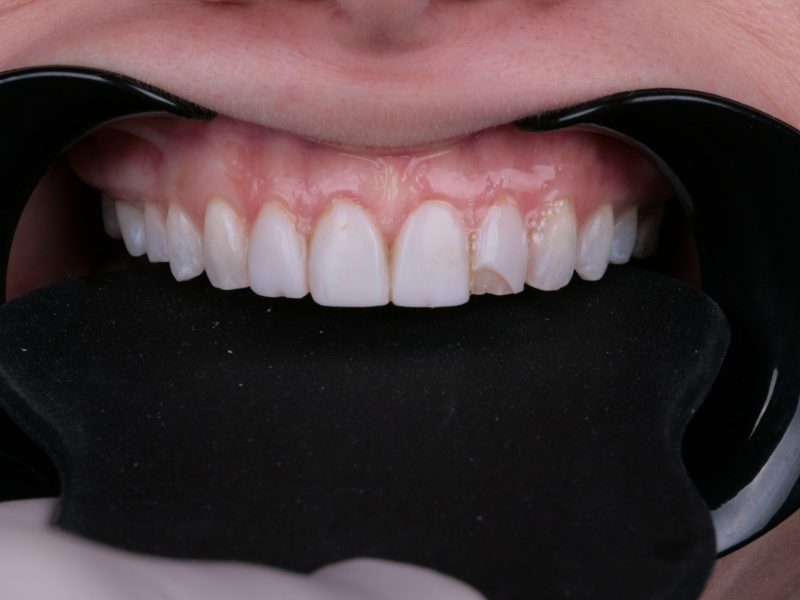 Teeth care solutions by Kelly Smile Design in Chicago